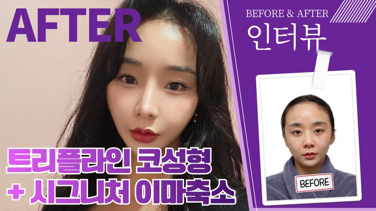 [Эйтоп Гоо сайхны мэс заслын эмнэлэг] Бид бодит мэс заслын дараах сэтгэгдлийг шууд асуулаа!! 😁I Илэн далангүй ярилцлагын видеог🎥 хамтдаа үзээрэй (Трипллайн хамар засах + Сигнатур дух багасгах мэс засал)