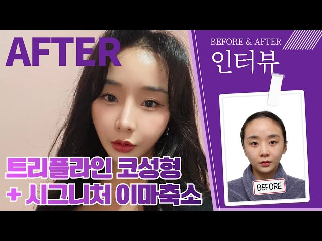 실제 수술 후기를 직접 물어봤습니다!! 😁I 솔직담백한 인터뷰 영상🎥 함께보시죠(트리플라인 코성형+시그니처 이마축소)