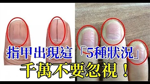 指甲出现“5种状况”千万不要忽视！通过观察指甲的状态，就可知身体健不健康！ - 天天要闻