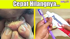 Hanya 3 Menit Kok.. Komedo Hilang Dengan Cepat Cuma Pakai Ini - Durasi: 3.01. Hanya 3 Menit Kok.. Komedo Hilang Dengan Cepat Cuma Pakai Ini - Durasi: 3.01.
