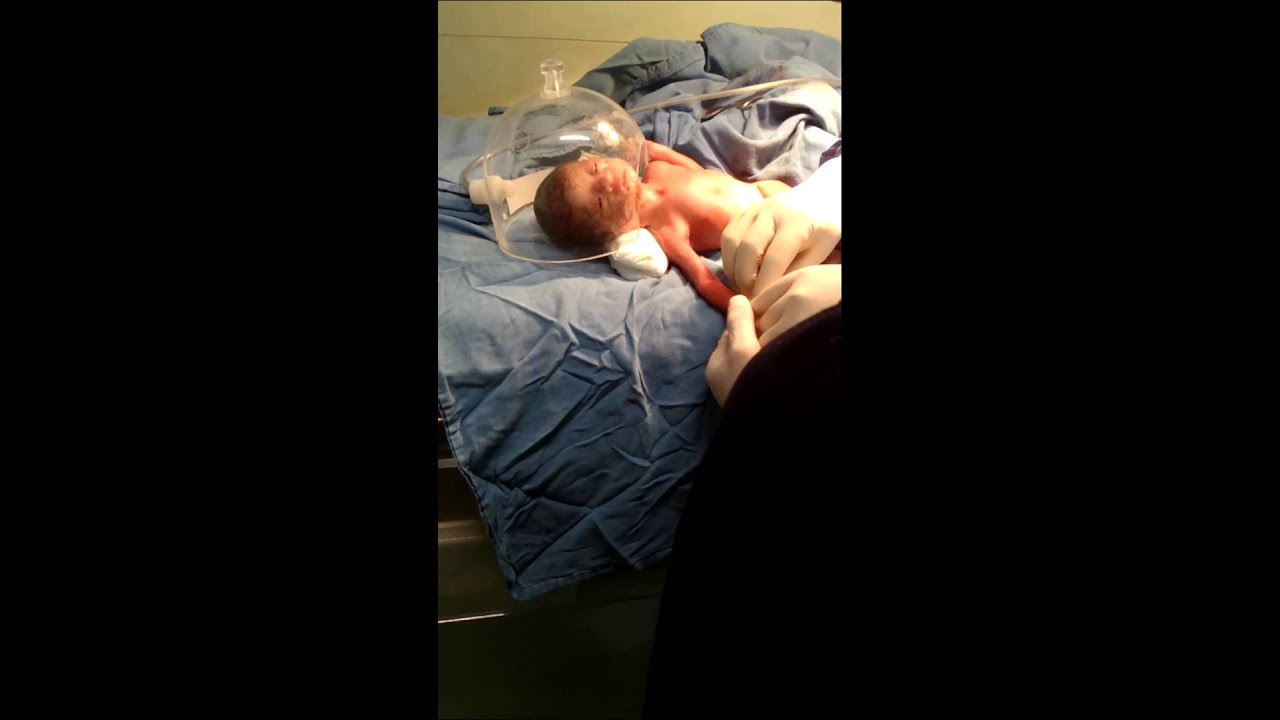Bebe prematuro de 29 SDE (SEMANAS DE GESTACION) - YouTube