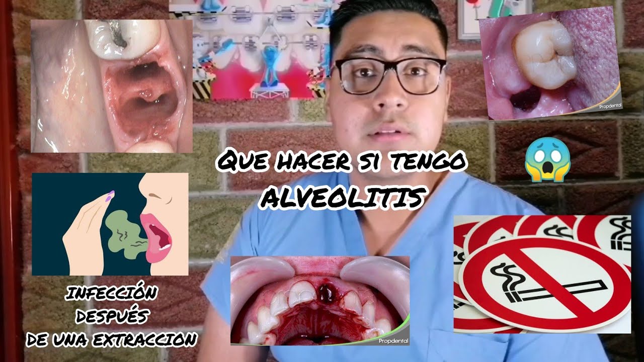 ¿infecciÓn Despues De Una Extraccion Que Hacer Si Tengo Alveolitis 