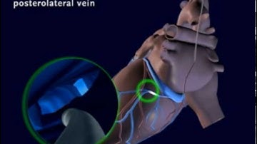 An Animated Demonstration of Placement of an LV lead in a Coronary Vein