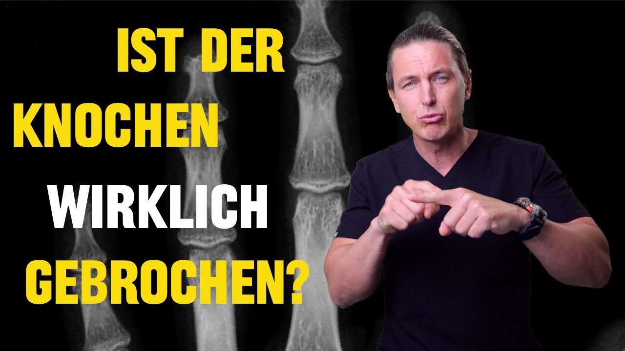Wie Fühlt Sich Ein Gebrochener Finger An