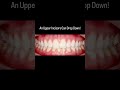Aligners used to have hype, now they don't work for everyone.