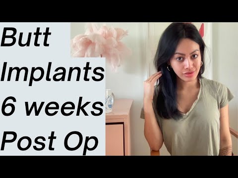 400 CC Butt Implants 6 Weeks Post Op | 12 Things To Expect