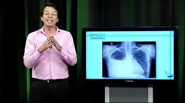 ¿Cuáles son las tres causas de derrame pleural?