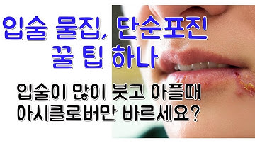 입술 물집 (단순포진) 치료 꿀팁 하나 알려 드립니다! (아시클로버 vs 티로서겔)