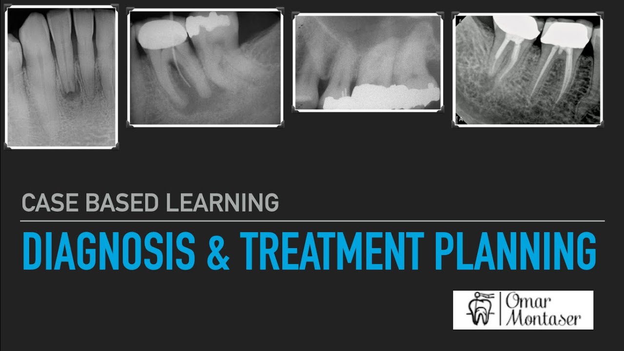 Case Based Learning: Diagnosis and Treatment Planning in Endodontics ...