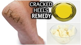 CRACKED HEELS HOME REMEDY │REMOVE DRY HEELS AT HOME FAST AND EASILY │HOW TO GET RID OF CRACKED FEET