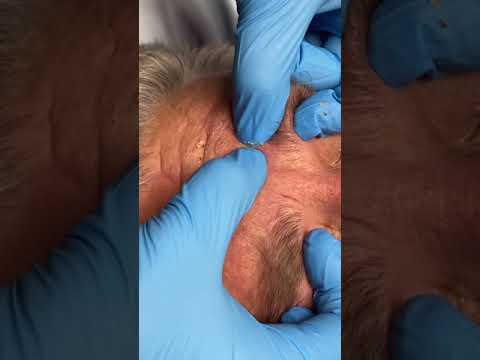 Blackhead Extractions