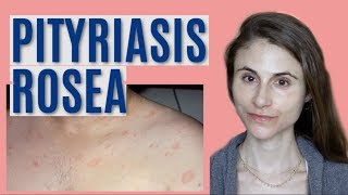 PITYRIASIS ROSEA: WHAT IT IS & GETTING RID OF IT| DR DRAY