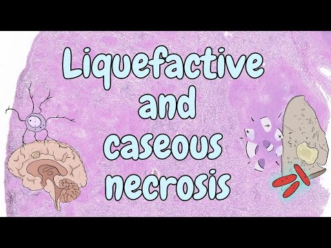 Liquefactive and caseous necrosis - general pathology