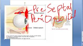 Ophthalmology 417 a Orbital Infection Orbital Cellulitis PreSeptal Post Septal Eye Swelling screenshot 4