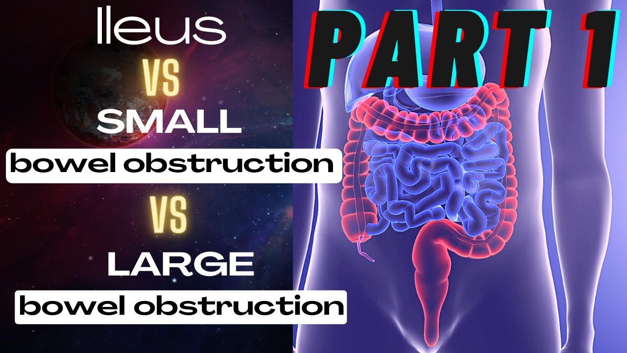 General Surgery Small Bowel Obstruction Vs Large Bowel Obstruction Vs Ileus Youtube 