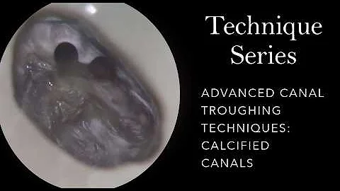 Troughing Calcified Cases: Advanced Canal Location Techniques