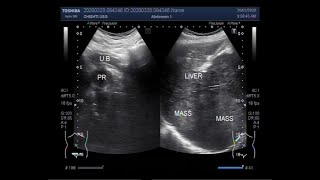 Ultrasound Video showing Hepatic Mass, Splenomegaly, Enlarged  Prostate, and ascites.