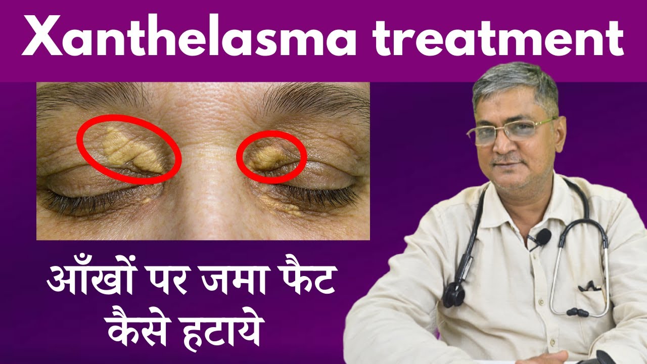 Xanthelasma Eye cholesterol kam karne ke upay eye cholesterol
