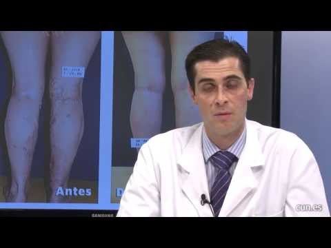 Video: Cómo curar las úlceras venosas de las piernas: 12 pasos (con imágenes)