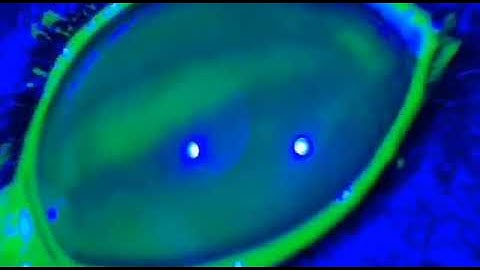 tear break up time video capture with QuikVue smartphone Eye Imaging Adaptor