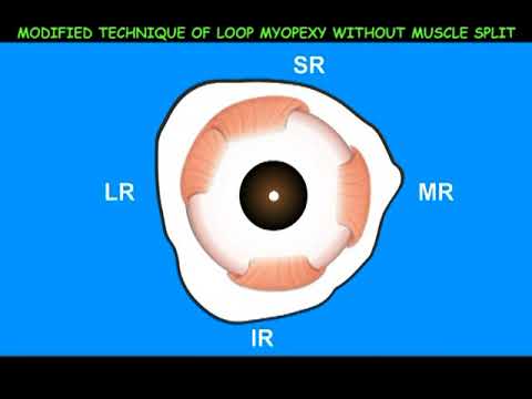 AIOC2018 - VT246 - Modified Loop Myopexy Without Muscle Split