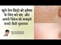 How to Get Rid of Open Pores Permanently I खुले रोम छिद्र कैसे ठीक करें | DR. MANOJ DAS