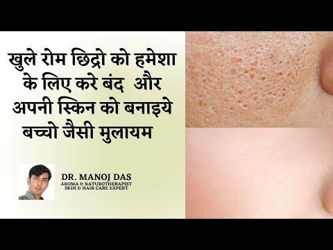 How to Get Rid of Open Pores Permanently I खुले रोम छिद्र कैसे ठीक करें | DR. MANOJ DAS