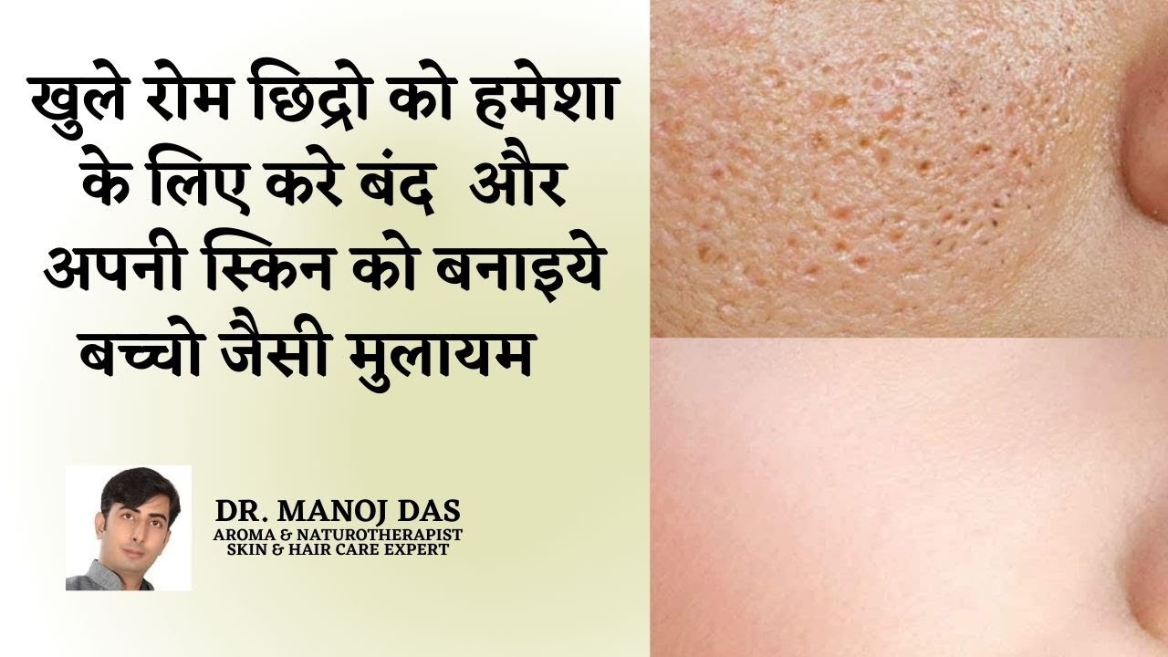 How to Get Rid of Open Pores Permanently I खुले रोम छिद्र कैसे ठीक करें | DR. MANOJ DAS