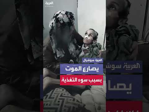 تدهور حالة الطفل الفلسطيني مصعب بسبب سوء التغذية الحاد.