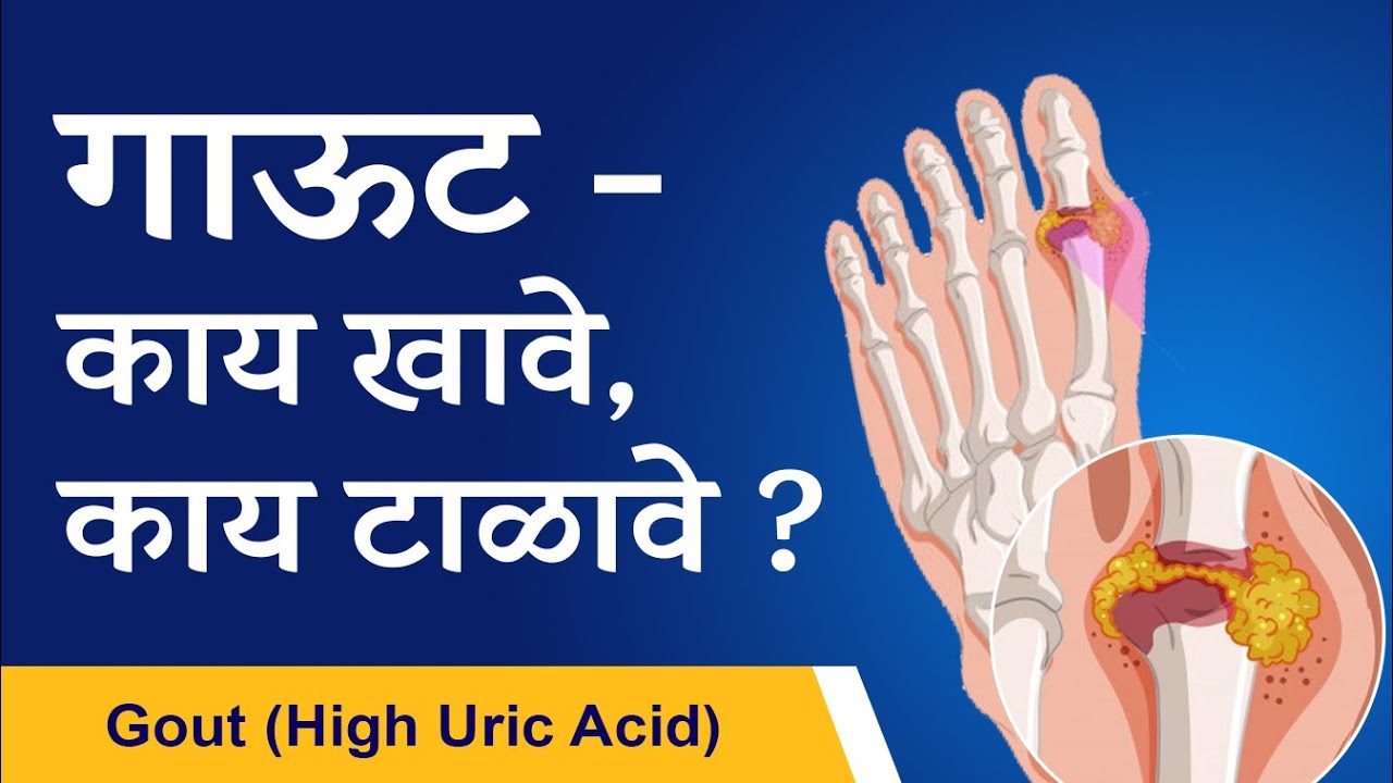 gout diet plan diet for high uric acid english dr tejas limaye youtube