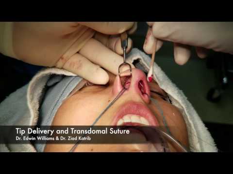Video thumbnail: Bulbous Tip Refinement Surgery (Closed Rhinoplasty)