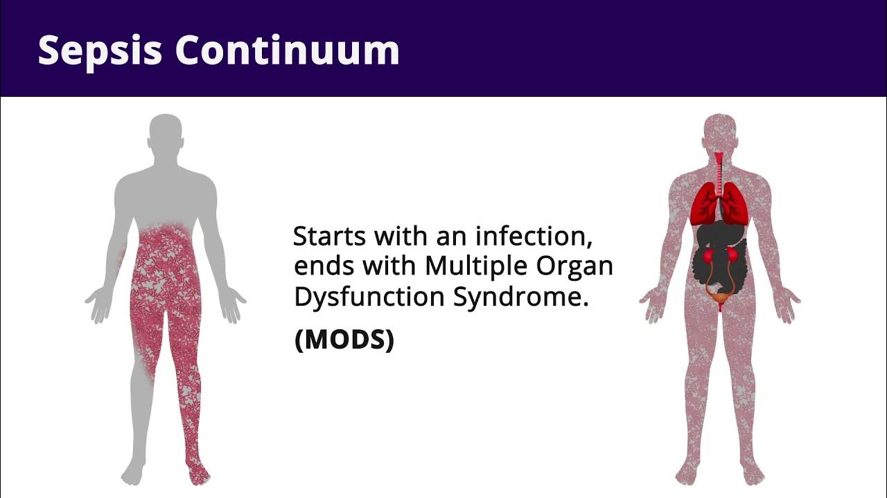 Nursing Interventions For Sepsis