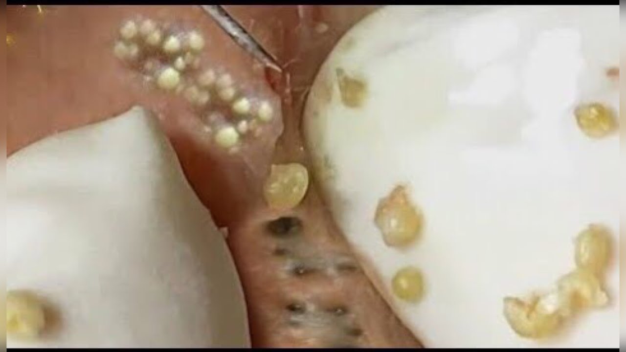 Best of removal blackheads YouTube