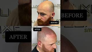 SCALP MICROPIGMENTATION BEFORE & AFTER