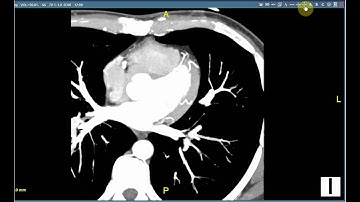 Inbuilt 3D Feature Demo - Saince Merge PACS