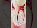 When Root Canal Tools Break Off 😨
