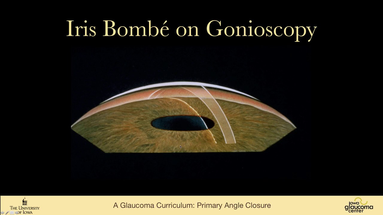 Iris Bombe Gonioscopy