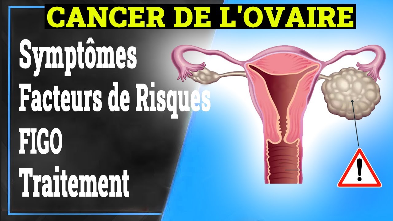 Cancer de l'Ovaire: Symptômes, Causes, Traitement | Gynécologie