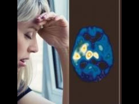 Video: Distimia: Cause, Sintomi E Diagnosi