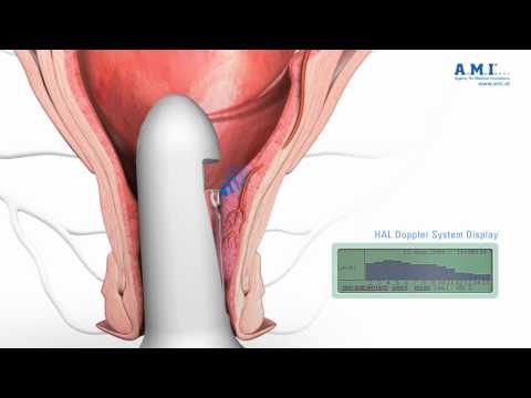 piles: HAL Hemorrhoidal Artery Ligation - new fast and painless treatment of haemorrhoids