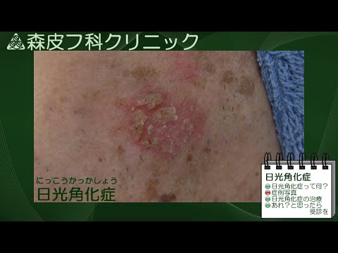動画による皮膚病の解説　第７回　【日光角化症】