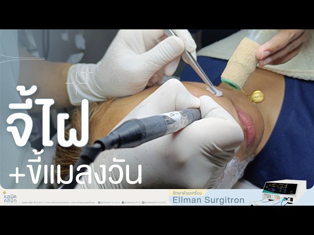 จี้ไฝ จี้ขี้แมลงวัน รีวิวขั้นตอนการทำแบบเจาะลึก ปลอดภัย ไม่ทิ้งรอย EP.389 @หมอปุ๊  Neramit Clinic