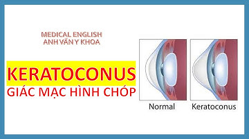 KERATOCONUS - BỆNH GIÁC MẠC HÌNH CHÓP