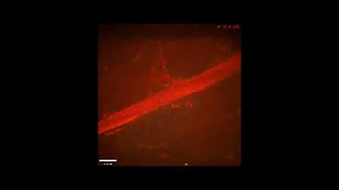 Lyme disease bacteria in bloodstream Borrelia Spirochete in the veins