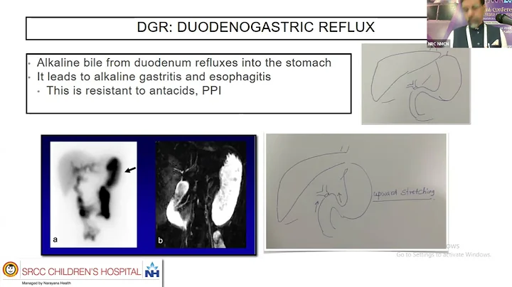Why roux en y Hepaticojejunost...  is better than ...