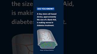 Stem cell-based treatment controls blood sugar in people with Type 1 Diabetes | #DiabetesResearch