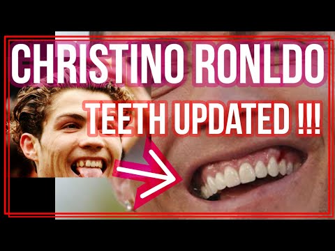 Christiano Ronaldo teeth newly updated!! before and after 🤓 then & now cosmetic transformation