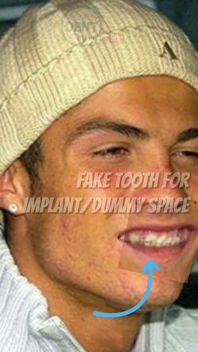 Christiano Ronaldo teeth newly updated!! before and after 🤓 then & now cosmetic transformation