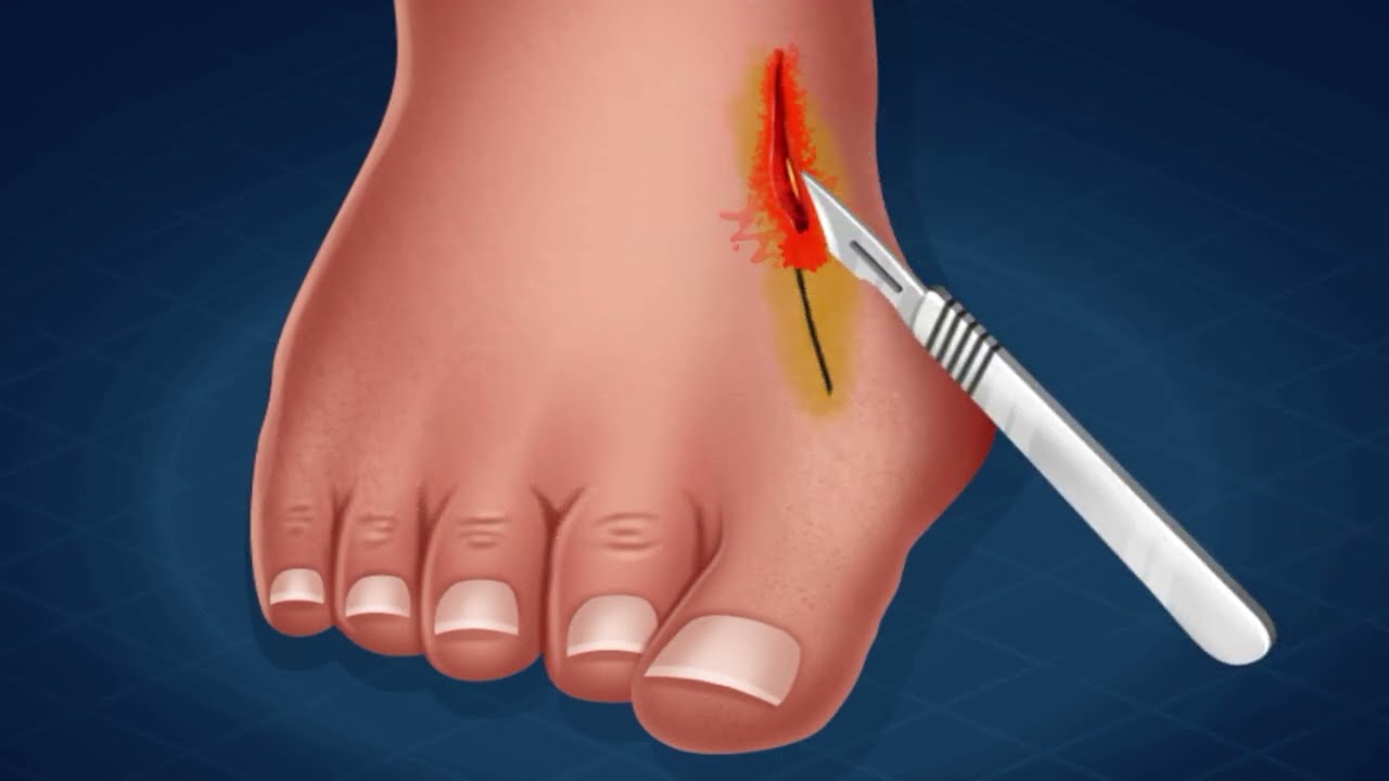 LAPIPLAST Y SURGERY 3animatione 