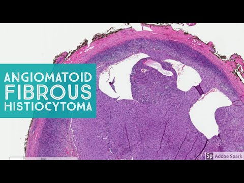 Video: Slicing, Dicing Thiab Biopsying Benign Histiocytoma